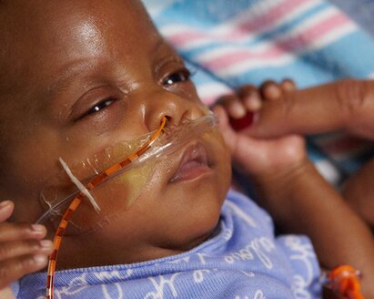 An infant with special feeding needs holds its mother's finger.